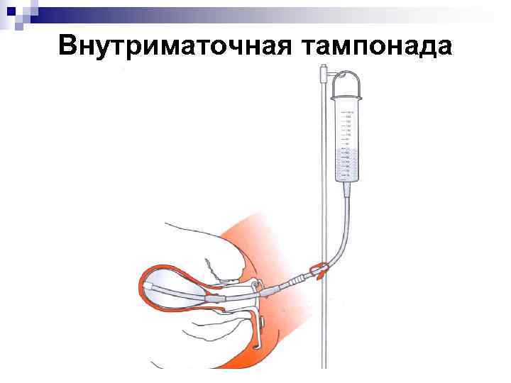 Внутриматочная тампонада 