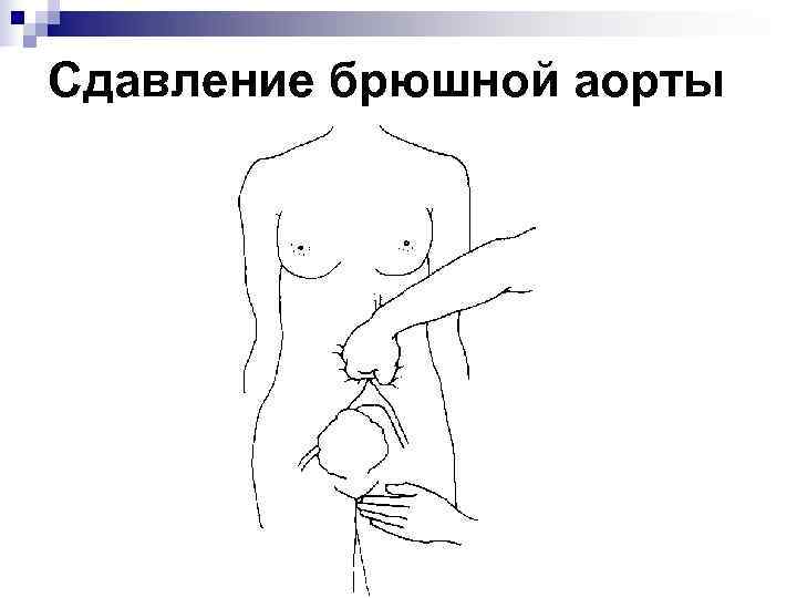 Сдавление брюшной аорты 