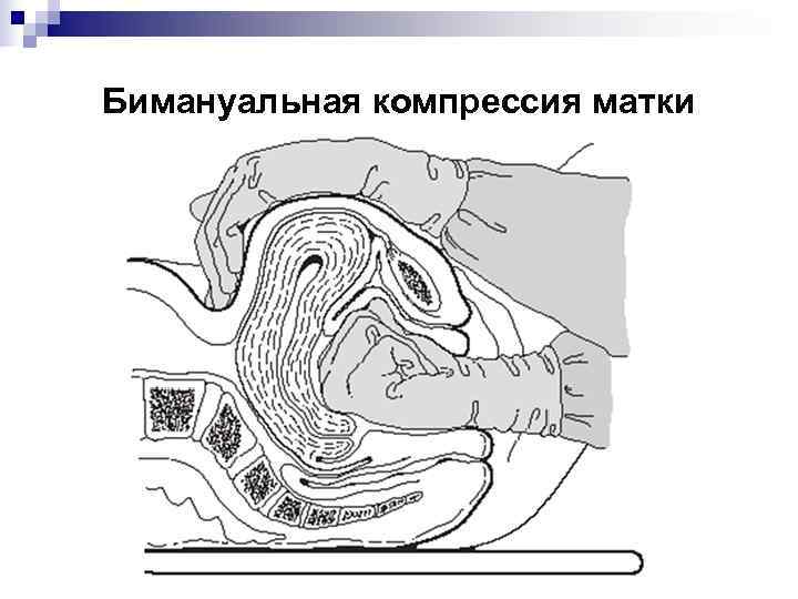 Бимануальная компрессия матки 