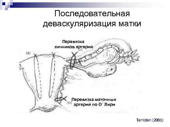 Перевязка маточных труб фото