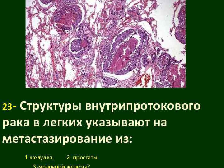 23 -  Структуры внутрипротокового рака в легких указывают на метастазирование из:  1