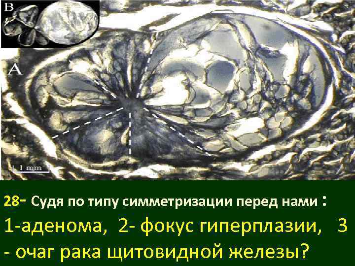 28 - Судя по типу симметризации перед нами : 1 -аденома, 2 - фокус