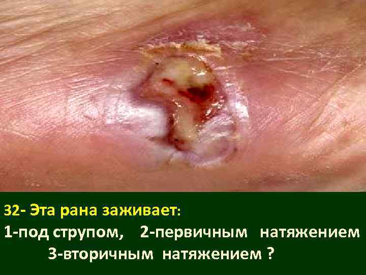 32 - Эта рана заживает: 1 -под струпом, 2 -первичным натяжением 3 -вторичным натяжением