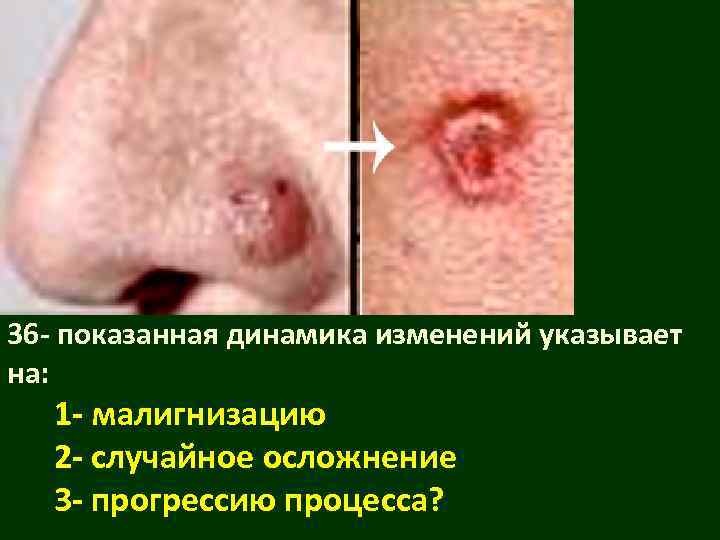 36 - показанная динамика изменений указывает на:  1 - малигнизацию  2 -