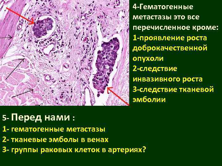       4 -Гематогенные      
