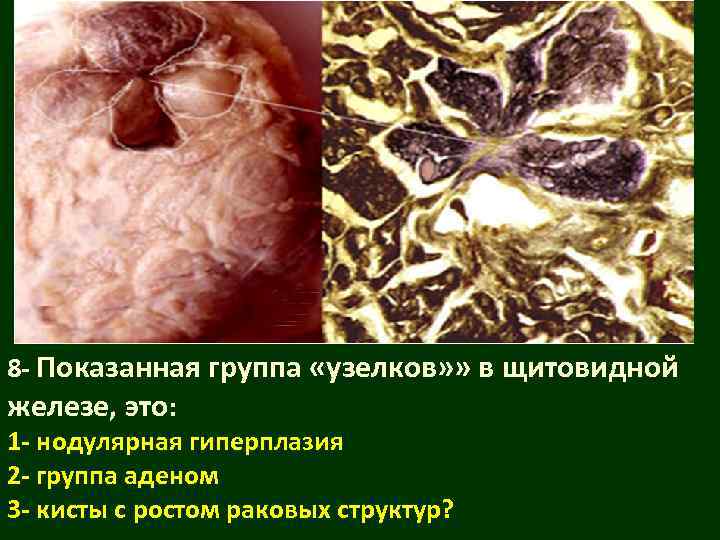 8 - Показанная группа «узелков» » в щитовидной железе, это: 1 - нодулярная гиперплазия