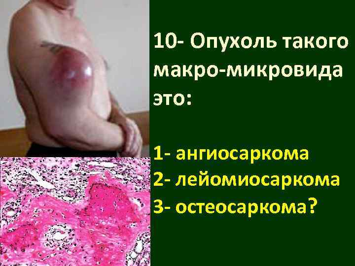 10 - Опухоль такого макро-микровида это:  1 - ангиосаркома 2 - лейомиосаркома 3