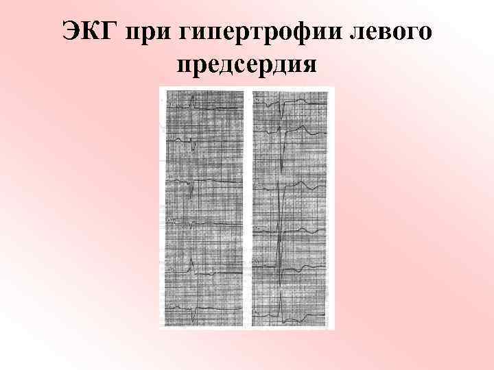 ЭКГ при гипертрофии левого предсердия 