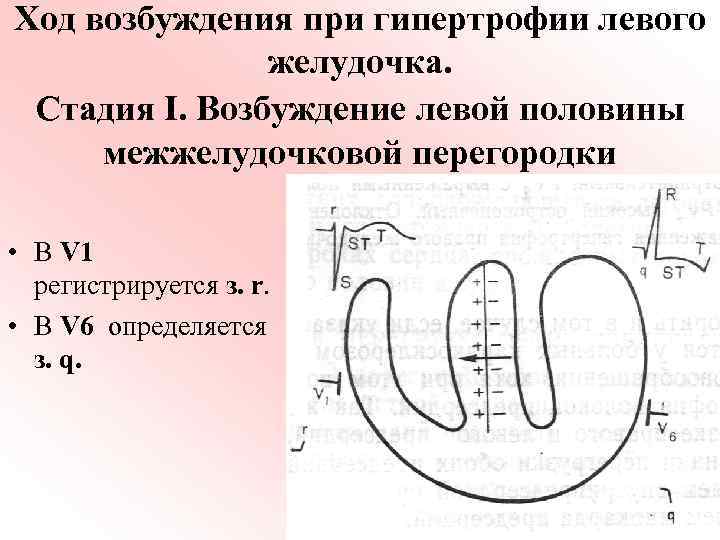 Ход возбуждения при гипертрофии левого желудочка. Стадия I. Возбуждение левой половины межжелудочковой перегородки •