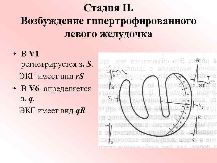 Стадия II. Возбуждение гипертрофированного левого желудочка • В V 1 регистрируется з. S. ЭКГ