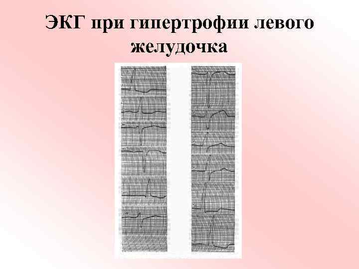 ЭКГ при гипертрофии левого желудочка 