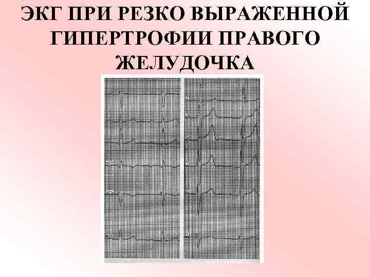 ЭКГ ПРИ РЕЗКО ВЫРАЖЕННОЙ ГИПЕРТРОФИИ ПРАВОГО ЖЕЛУДОЧКА 