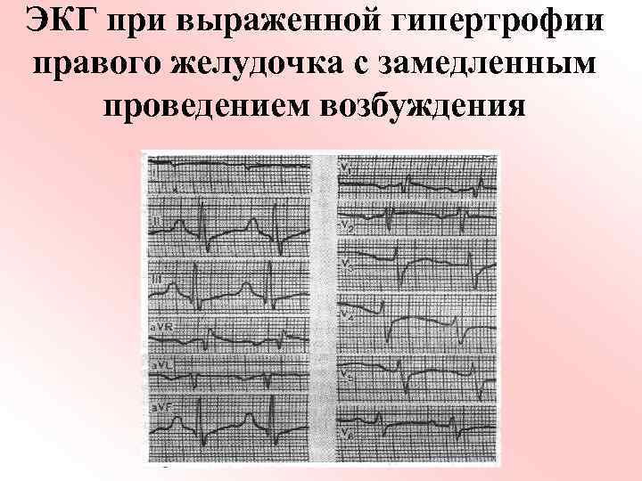 ЭКГ при выраженной гипертрофии правого желудочка с замедленным проведением возбуждения 
