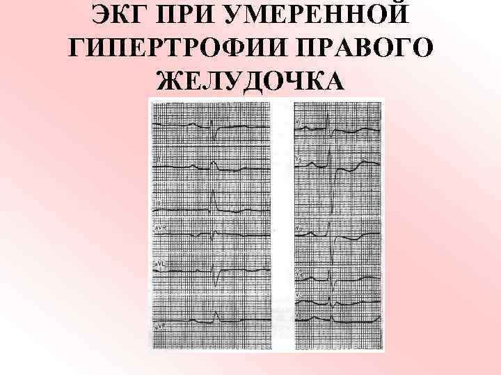 ЭКГ ПРИ УМЕРЕННОЙ ГИПЕРТРОФИИ ПРАВОГО ЖЕЛУДОЧКА 