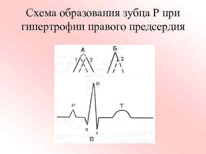 Схема образования зубца Р при гипертрофии правого предсердия 