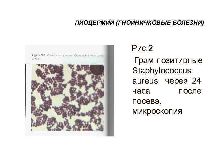 ПИОДЕРМИИ (ГНОЙНИЧКОВЫЕ БОЛЕЗНИ)    Рис. 2    Грам-позитивные  
