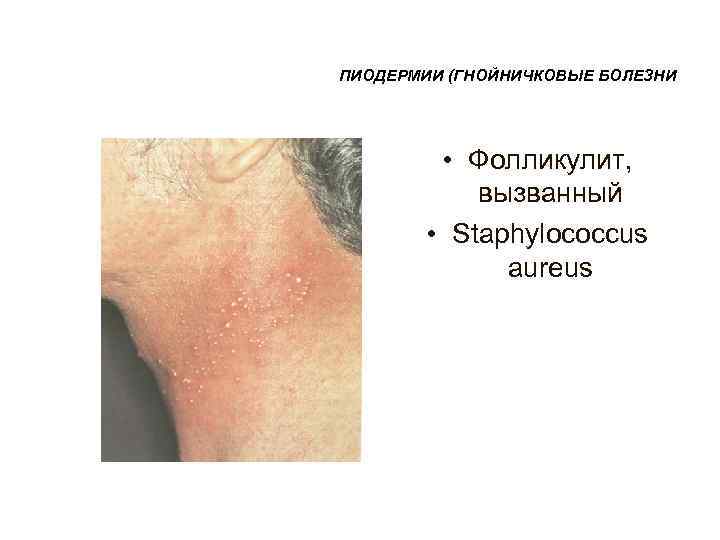 ПИОДЕРМИИ (ГНОЙНИЧКОВЫЕ БОЛЕЗНИ   • Фолликулит,   вызванный   • Staphylococcus