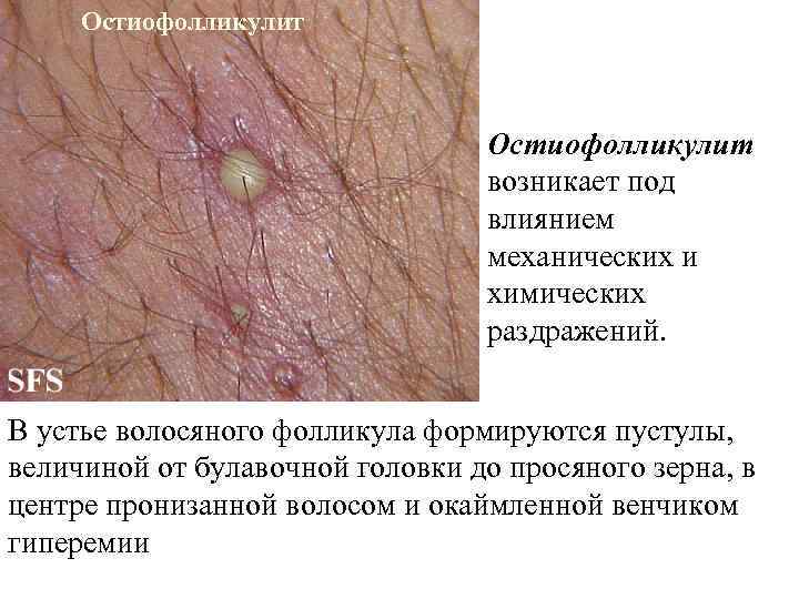  Остиофолликулит       возникает под    