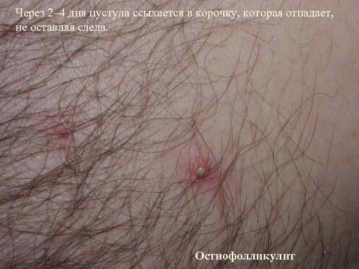 Через 2– 4 дня пустула ссыхается в корочку, которая отпадает,  не оставляя следа.