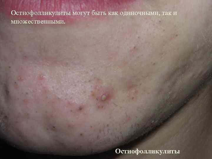 Остиофолликулиты могут быть как одиночными, так и множественными.      
