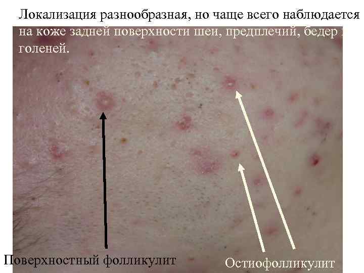  Локализация разнообразная, но чаще всего наблюдается  на коже задней поверхности шеи, предплечий,