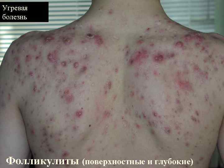 Угревая болезнь Фолликулиты (поверхностные и глубокие) 