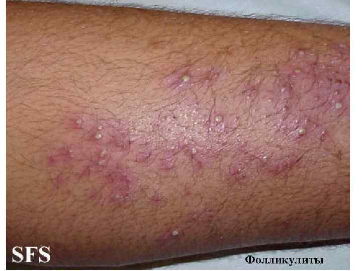 Фолликулиты 