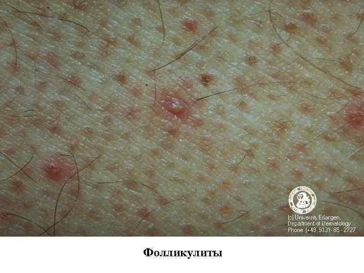 Фолликулиты 