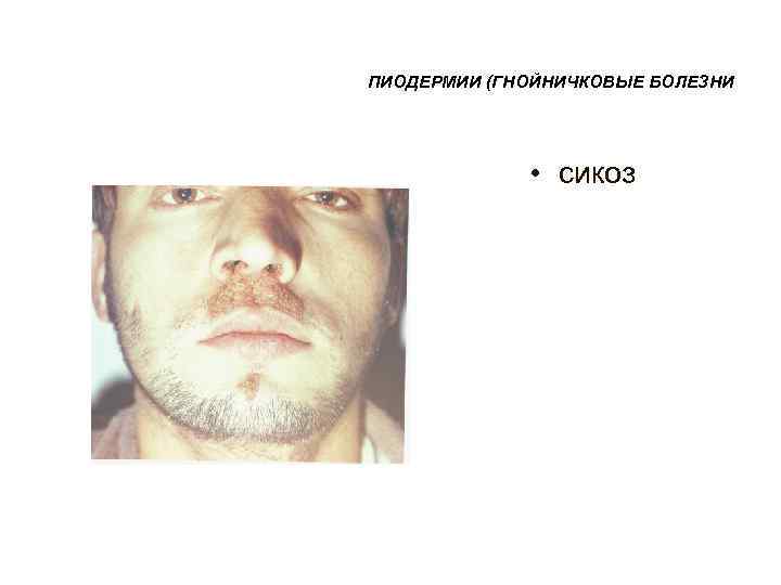 ПИОДЕРМИИ (ГНОЙНИЧКОВЫЕ БОЛЕЗНИ    • сикоз 