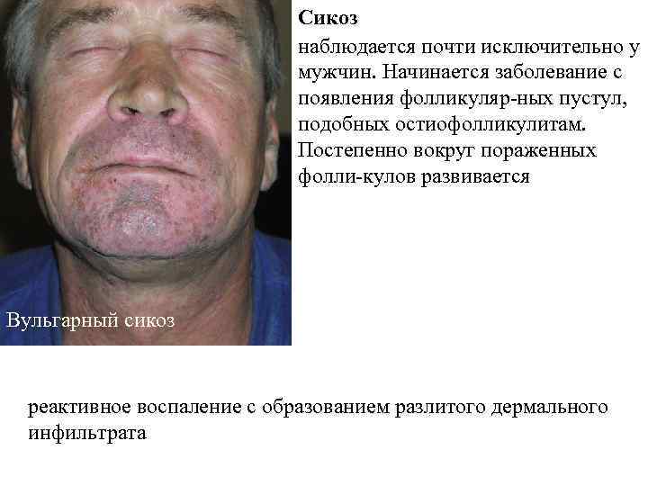      Сикоз      наблюдается почти исключительно