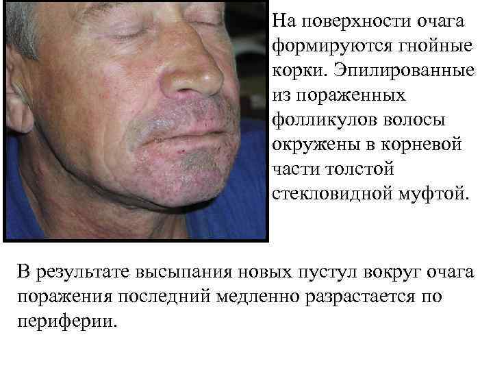       На поверхности очага     формируются