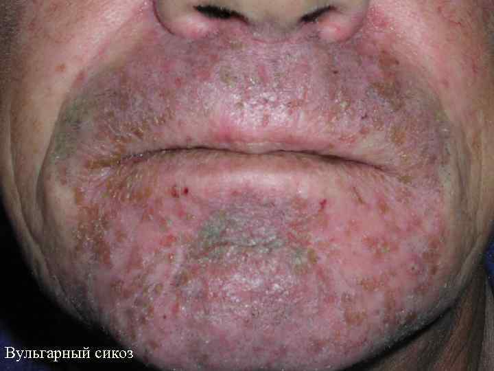 Вульгарный сикоз 