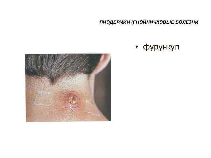 ПИОДЕРМИИ (ГНОЙНИЧКОВЫЕ БОЛЕЗНИ   • фурункул 
