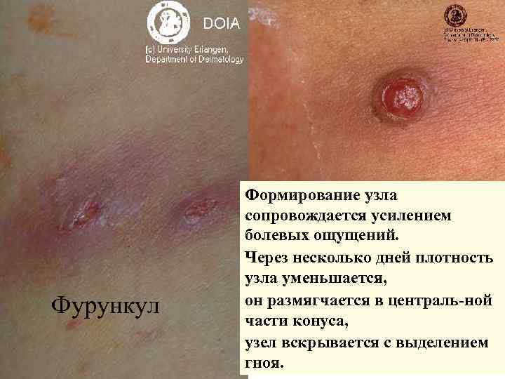   Формирование узла  сопровождается усилением  болевых ощущений.   Через несколько