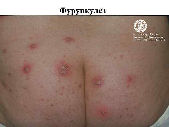 Фурункулез 