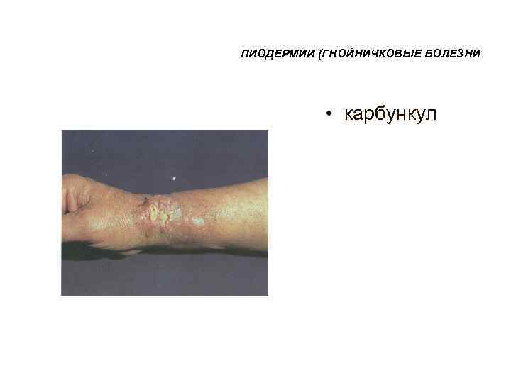 ПИОДЕРМИИ (ГНОЙНИЧКОВЫЕ БОЛЕЗНИ    • карбункул 