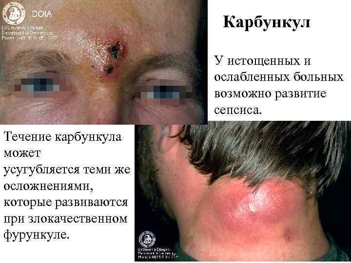      Карбункул     У истощенных и 