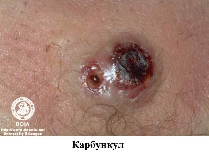 Карбункул 