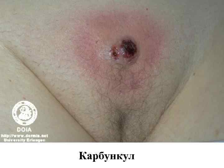 Карбункул 