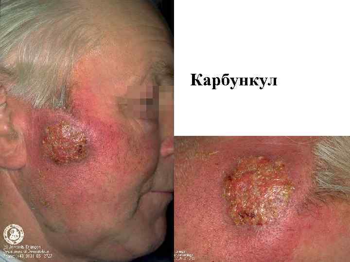 Карбункул 
