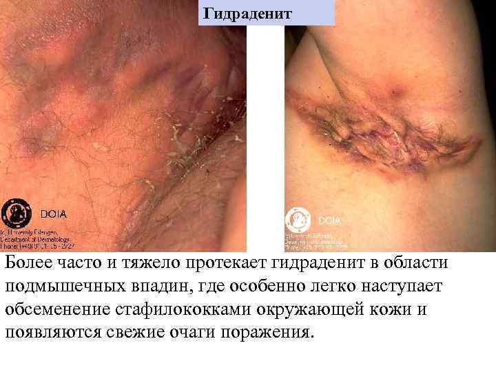      Гидраденит Более часто и тяжело протекает гидраденит в области