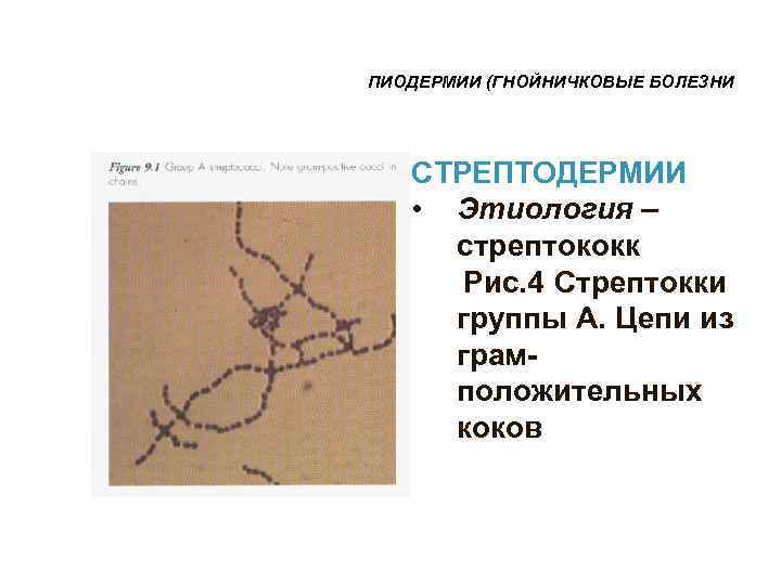 ПИОДЕРМИИ (ГНОЙНИЧКОВЫЕ БОЛЕЗНИ  СТРЕПТОДЕРМИИ • Этиология – стрептококк  Рис. 4 Стрептокки группы