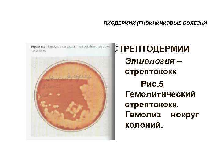 ПИОДЕРМИИ (ГНОЙНИЧКОВЫЕ БОЛЕЗНИ  СТРЕПТОДЕРМИИ  • Этиология – стрептококк  Рис. 5 Гемолитический