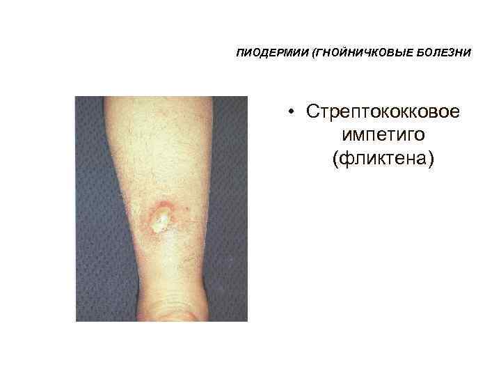 ПИОДЕРМИИ (ГНОЙНИЧКОВЫЕ БОЛЕЗНИ  • Стрептококковое   импетиго  (фликтена) 