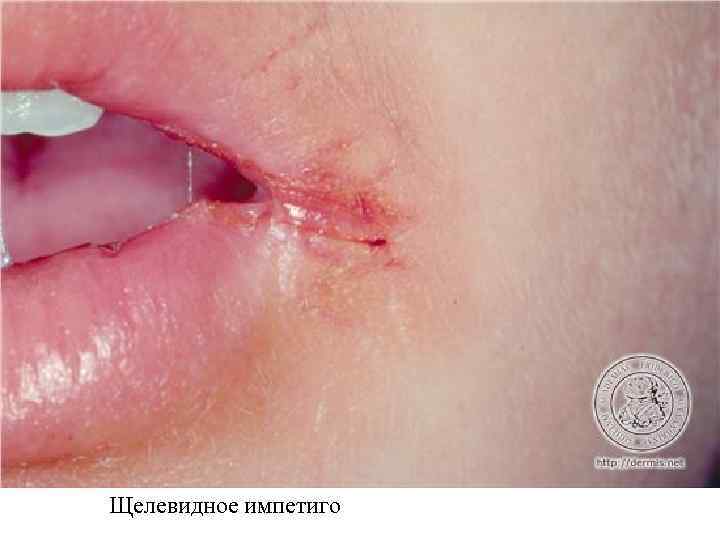 Щелевидное импетиго 