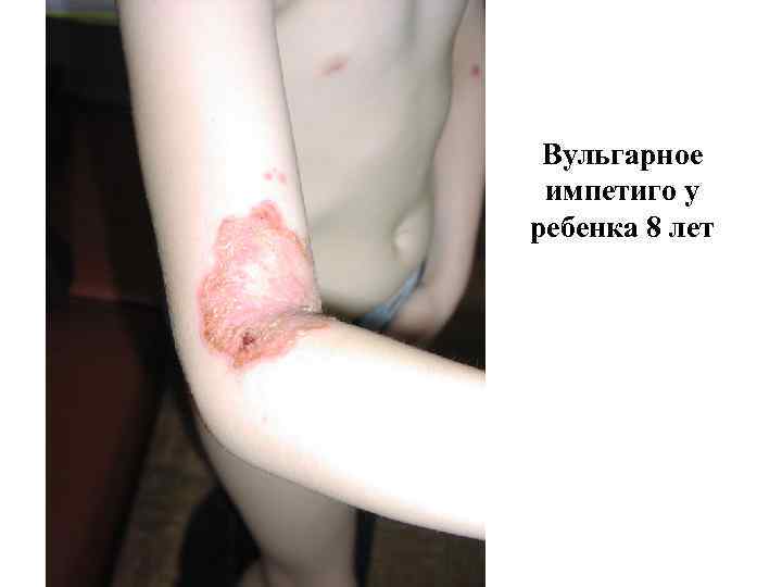  Вульгарное импетиго у ребенка 8 лет 