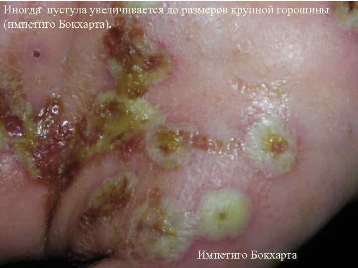 Иногда пустула увеличивается до размеров крупной горошины (импетиго Бокхарта).    Импетиго Бокхарта