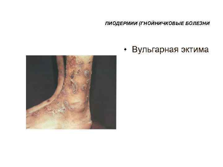 ПИОДЕРМИИ (ГНОЙНИЧКОВЫЕ БОЛЕЗНИ  • Вульгарная эктима 