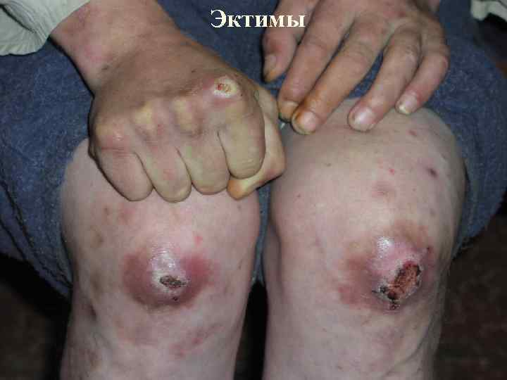 Эктимы 