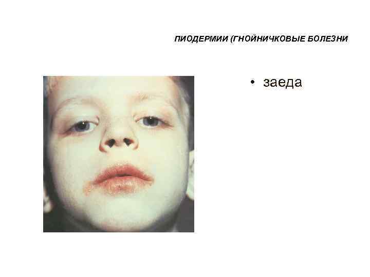 ПИОДЕРМИИ (ГНОЙНИЧКОВЫЕ БОЛЕЗНИ    • заеда 